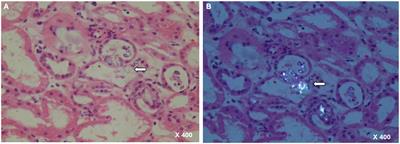 Case report: Acute oxalate nephropathy due to traditional medicinal herbs